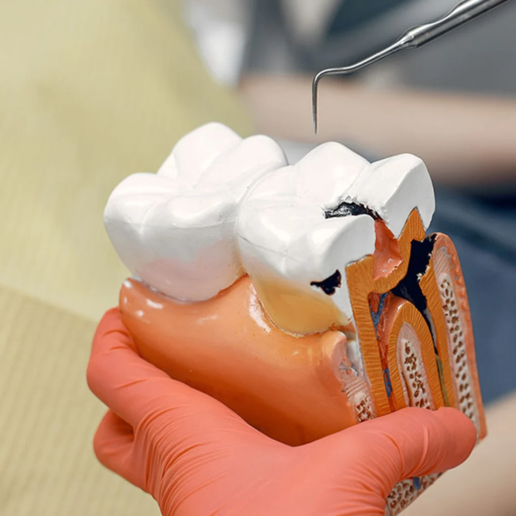 Root Canal Treatments 1 after root canal treatment