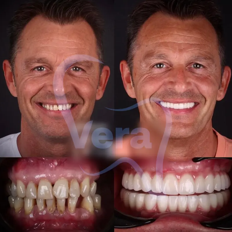 dental implants in turkey