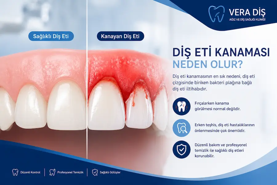 Diş Eti Kanaması Neden Olur? Ne Zaman Önemlidir? 1 gingivitis ile periodontitis arasindaki fark